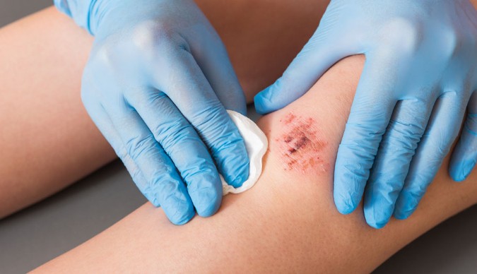 Ghrita-based formulations in Dushta Vrana: Yashtimadhu and medicated ghee for deep tissue healing